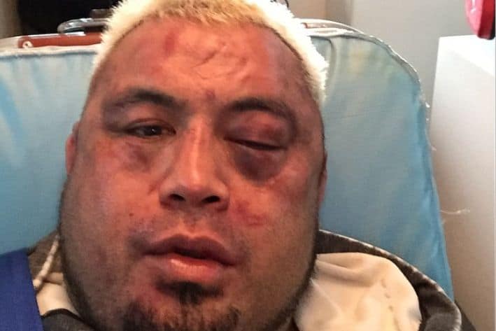 Mark Hunt Posts Picture Of Swollen Face After TKO Loss