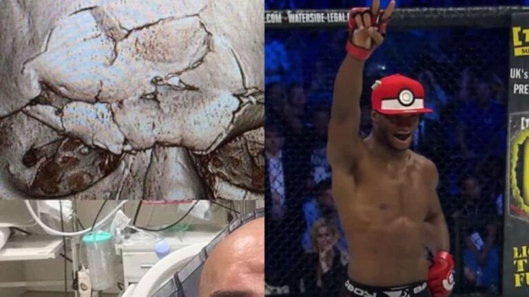 Pics: Cyborg’s Skull Was Literally Crushed By Michael Page’s Knee