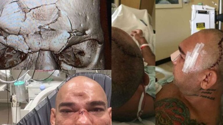 Graphic Pics: Cyborg’s Skull Before & After Surgery