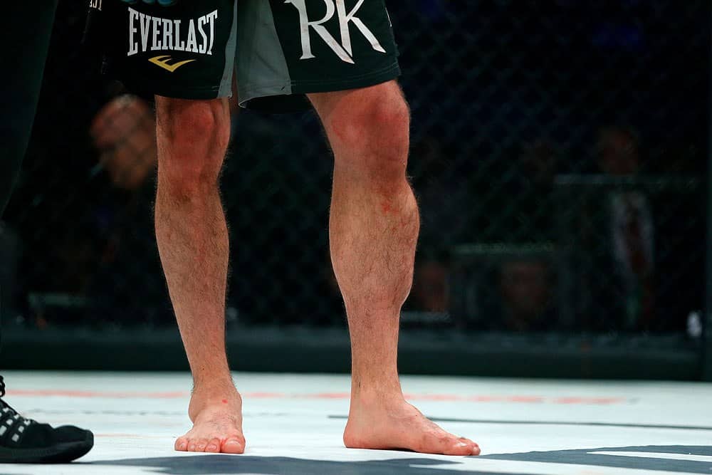 Rory MacDonald Describes 'Worst Pain' He's Ever Felt At Bellator 192 1 RoryMacDonaldLeg