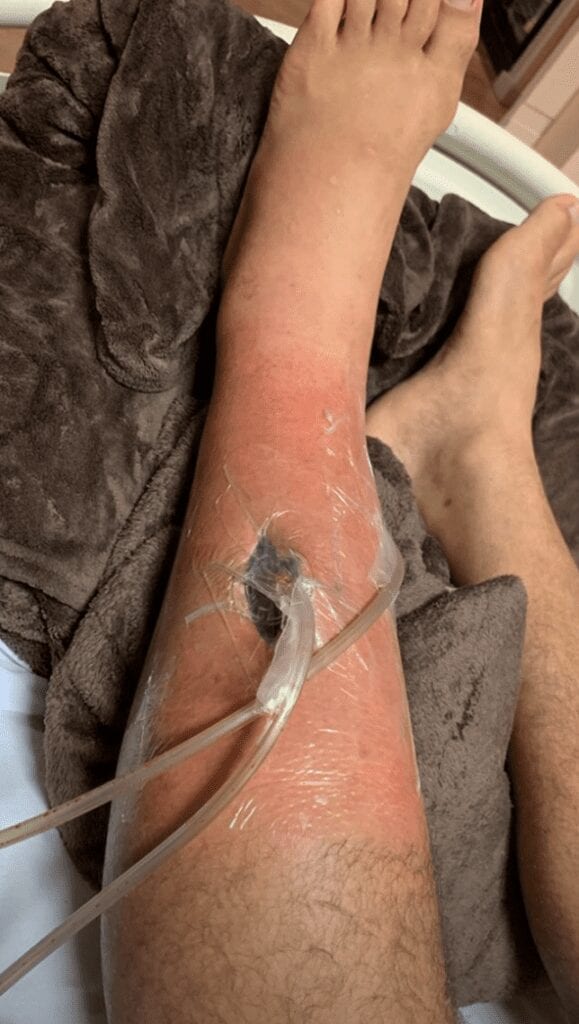 Junior dos Santos Shares Graphic Images Of Infected Leg (Photos) 3 Screen Shot 2019 10 23 at 3.36.52 PM 579x1024 1
