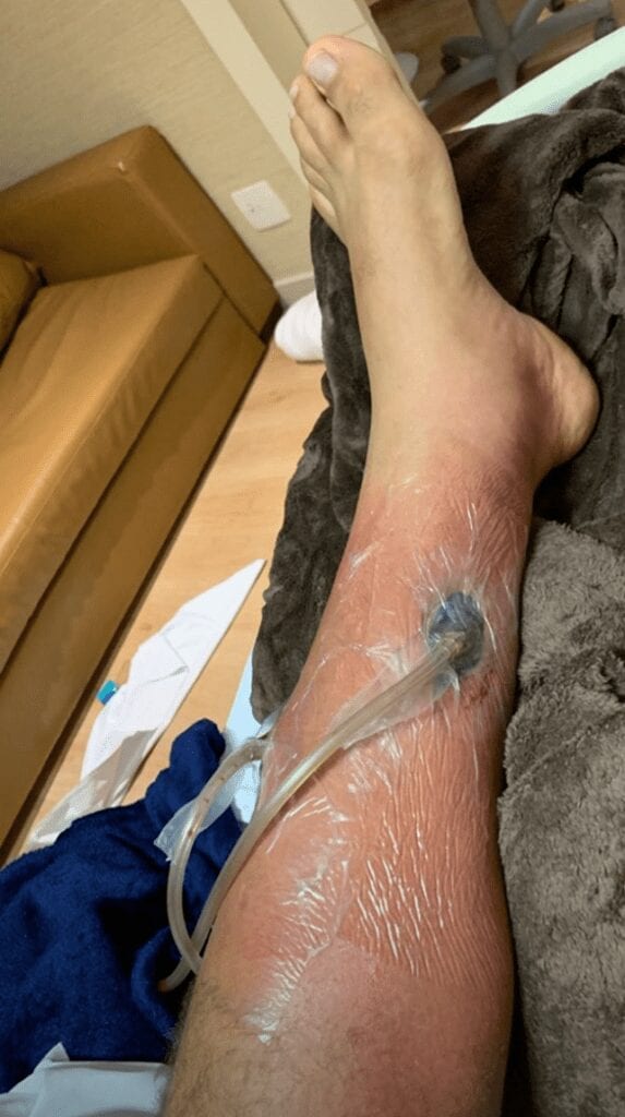 Junior dos Santos Shares Graphic Images Of Infected Leg (Photos) 4 Screen Shot 2019 10 23 at 3.36.56 PM 573x1024 1