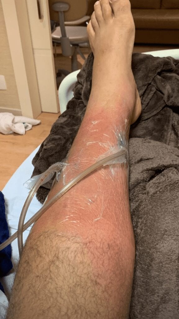 Junior dos Santos Shares Graphic Images Of Infected Leg (Photos) 5 Screen Shot 2019 10 23 at 3.37.01 PM 576x1024 1