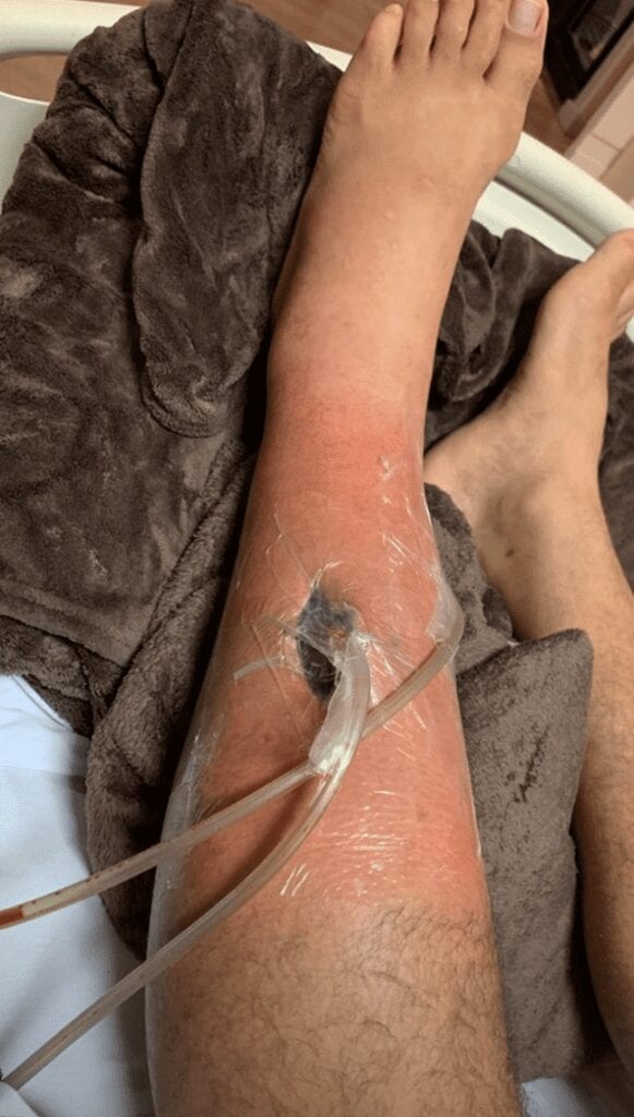 Junior dos Santos Shares Graphic Images Of Infected Leg (Photos) 6 Screen Shot 2019 10 23 at 3.37.07 PM 581x1024 1