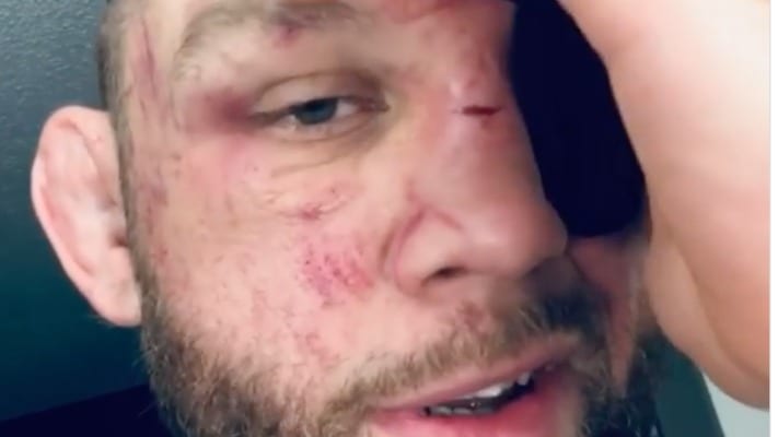 Nik Lentz Reveals Extent Of Injuries From Arnold Allen Eye Poke (Video)