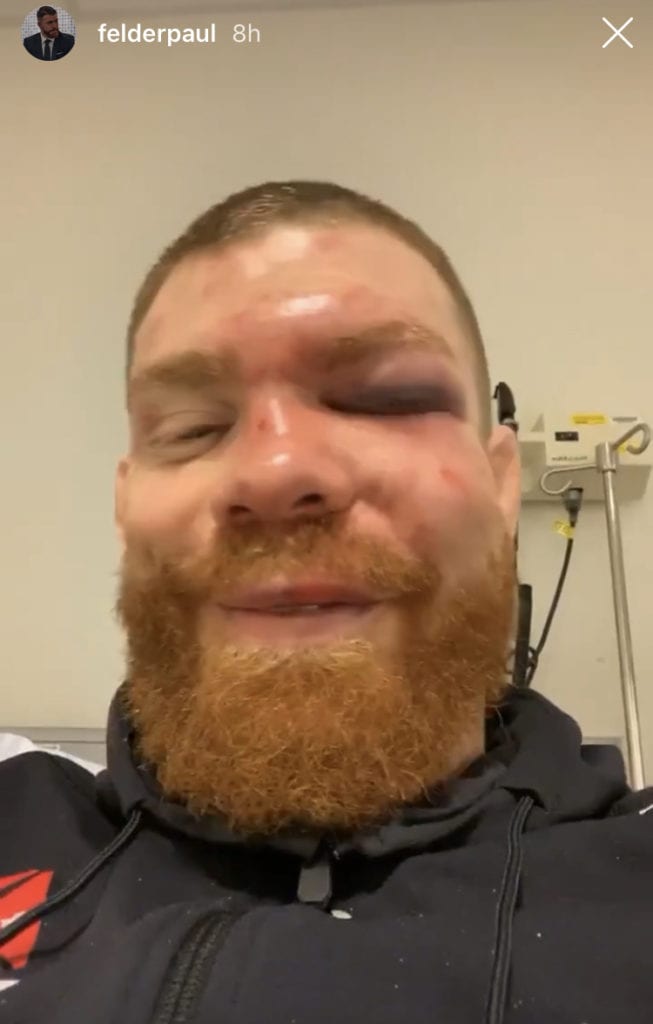 PHOTO: Paul Felder Reveals Facial Injury Suffered At UFC Auckland 2 image0 19