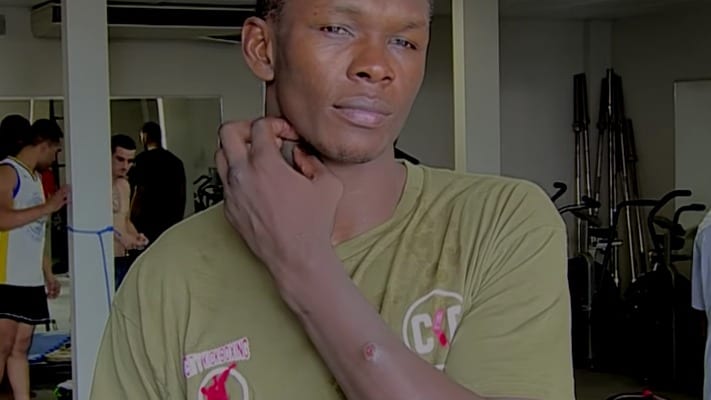 Does Israel Adesanya Have A Staph Infection Ahead Of UFC 248? (Photo)