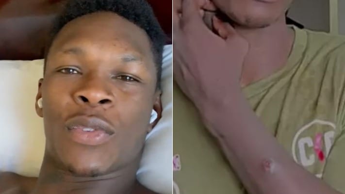 Israel Adesanya Denies Having Staph Infection Ahead Of UFC 248