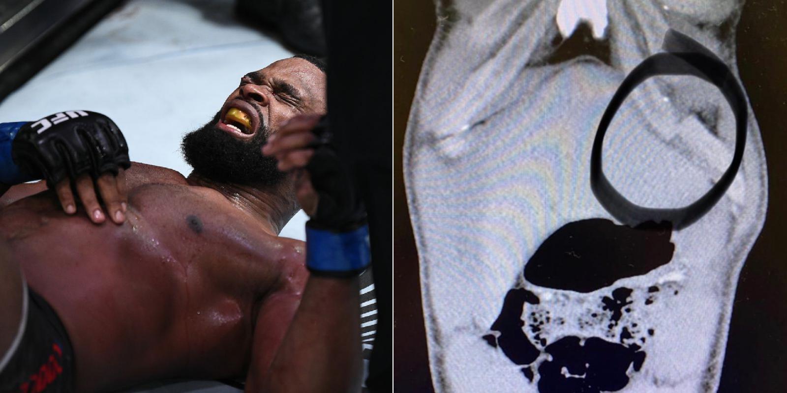 Update: Tyron Woodley Breaks Rib, Shares X-Ray Image 1 Woodley