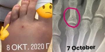 Khabib Nurmagomedov Posts X-Ray Image Of Broken Foot Suffered Prior To UFC 254 2 Khabib
