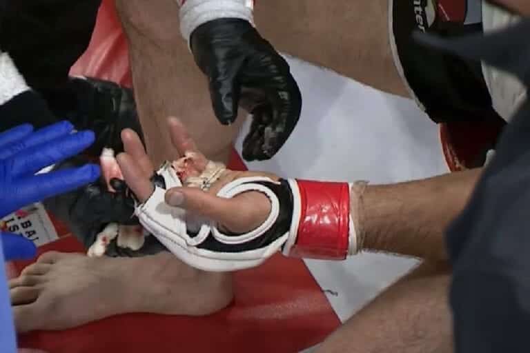 Khetag Pliev Loses Finger At CFFC 94