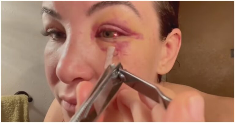 VIDEO | Miesha Tate Removes Her Own Stitches