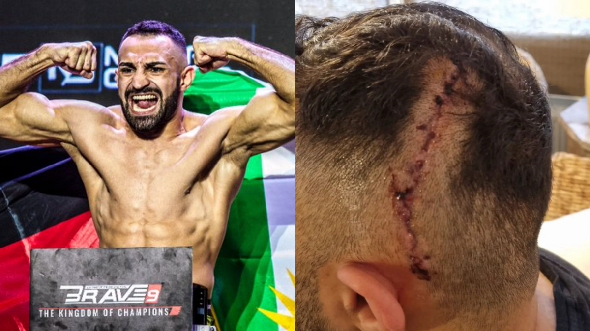 Bellator Fighter Alan Omer's Brain Tumour 'Removed To 100 Percent,' Plans to 'Make History' With Comeback 1 Alan Omer Brain Tumor