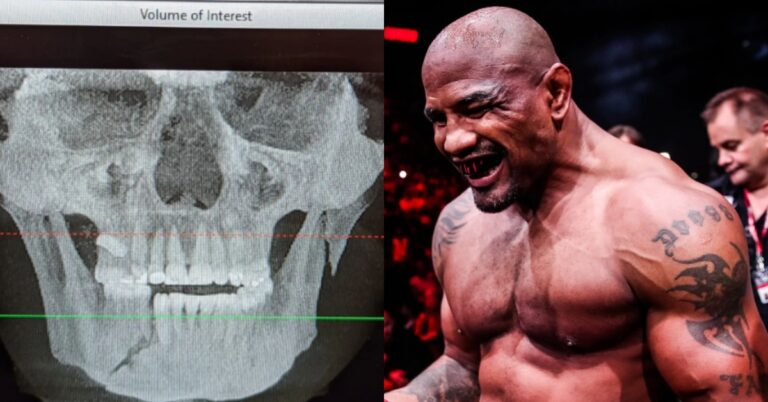 Alex Polizzi Shares X-Ray After Suffering Fractured Jaw Against Yoel Romero In KO Loss At Bellator 280