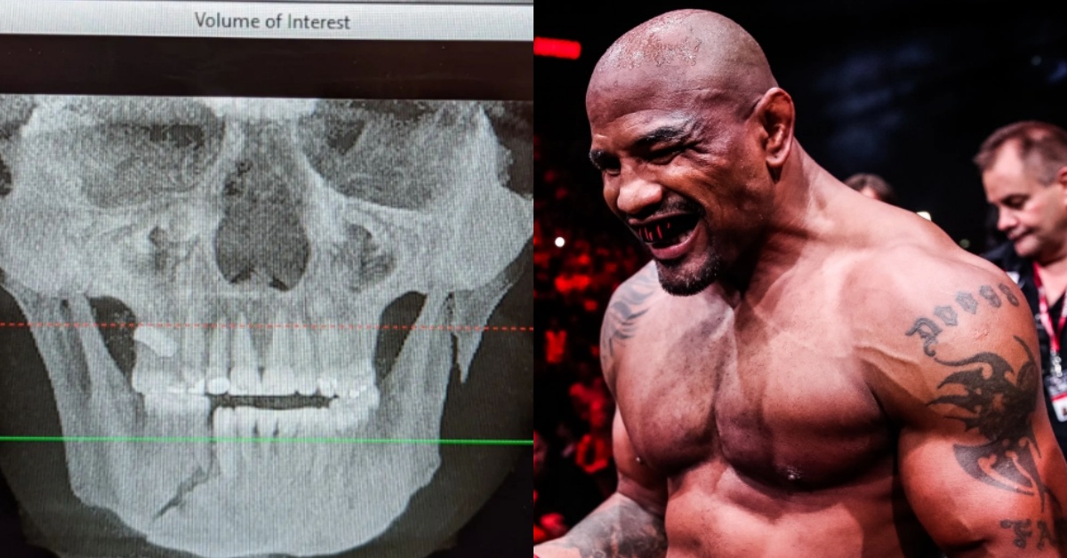 Alex Polizzi Shares X-Ray After Suffering Fractured Jaw Against Yoel Romero In KO Loss At Bellator 280 1 Yoel Romero