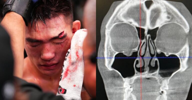Song Yadong reveals he suffered fractured orbital in loss to Cory Sandhagen, experiencing triple vision