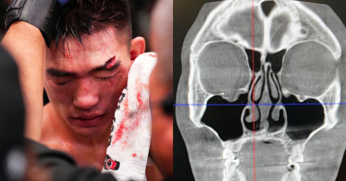 Song Yadong reveals he suffered fractured orbital in loss to Cory Sandhagen, experiencing triple vision 1 Song Yadong