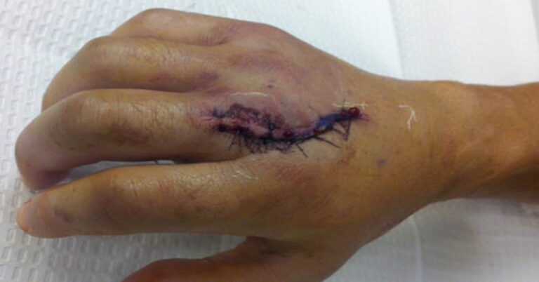 Gross Picture of the Day: Dominick Cruz’s Hand
