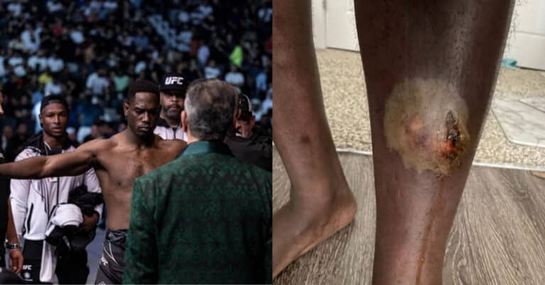 AJ Dobson suffered hematoma which developed into horrific abscess following UFC 280 loss: “Within two days I was unable to walk.”