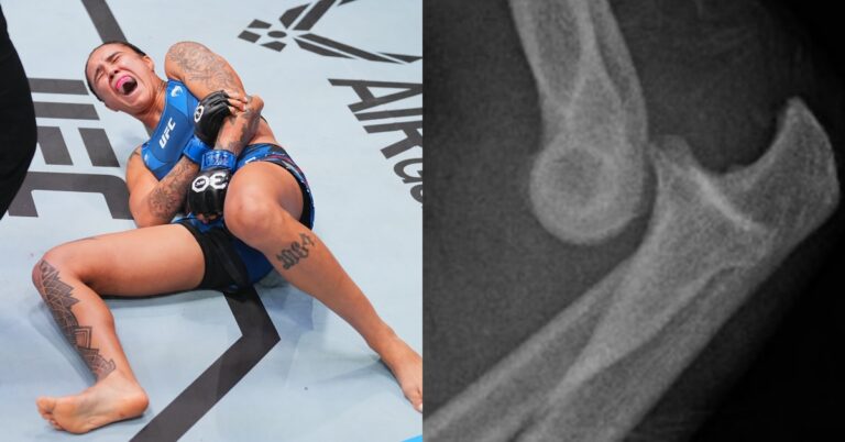 Photo – Horrific x-Ray shows gruesome elbow injury suffered by Istela Nunes in UFC Vegas 77 fight