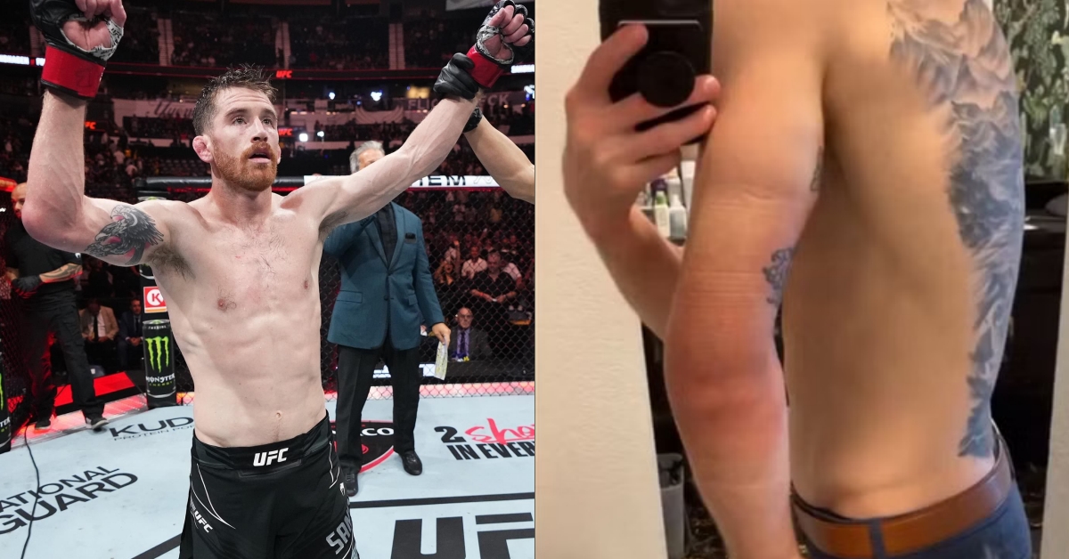 Cory Sandhagen set for surgery after suffering full tricep tear at UFC Nashville, shows off gruesome injury 1 Cory Sandhagen suffers entire tricep tear at UFC Nashville set for surgery