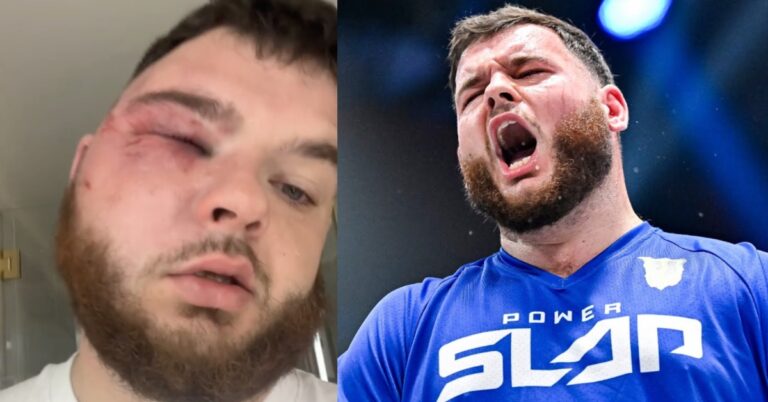 video: Power Slap Fighter ‘Turp Daddy Slim’ Shows Off gnarly facial injury following Latest event