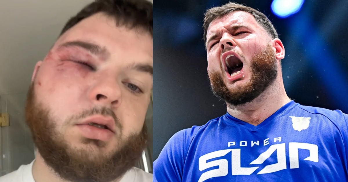 video: Power Slap Fighter 'Turp Daddy Slim' Shows Off gnarly facial injury following Latest event 1 Power Slap