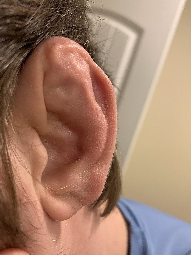 Cauliflower Ear