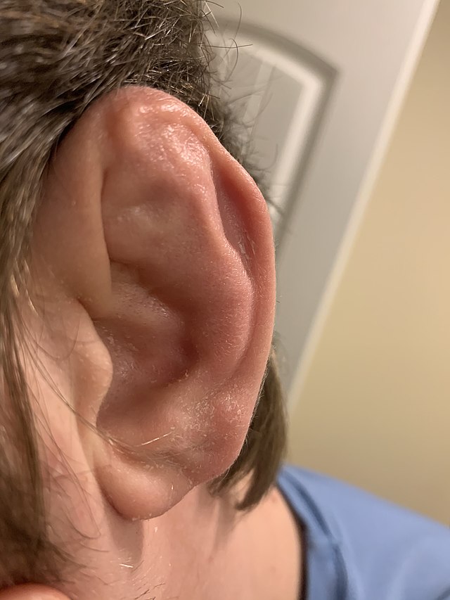 Worst Cauliflower Ear In UFC & MMA 2 Cauliflower Ear