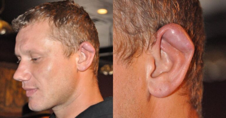 Worst Cauliflower Ear In UFC & MMA