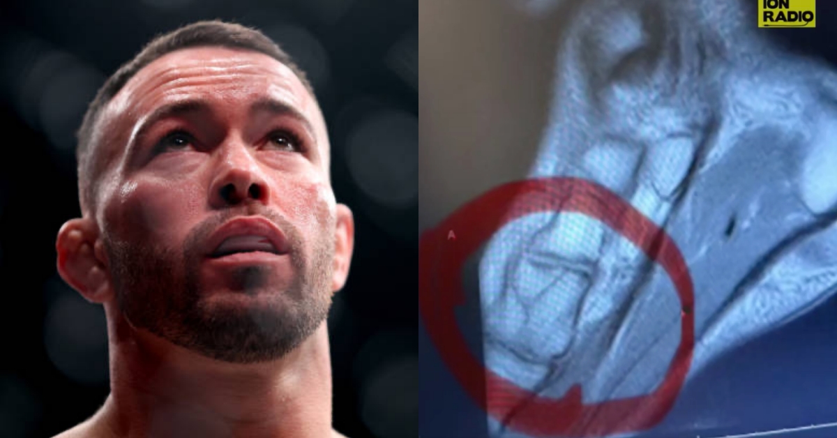 Colby Covington reveals x-rays of fractured foot suffered at UFC 296 I broke it right away
