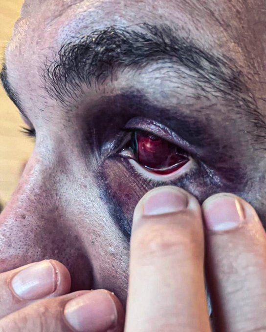 Chris Weidman continues to defend his double eye-poke victory over Bruno Silva: 'MMA is a tough sport' 4 Chris Weidman eyeball