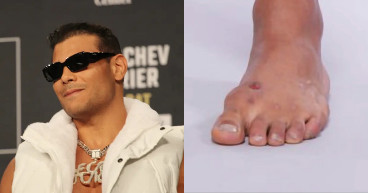 Fans react after photo suggests Paulo Costa is battling staph infection ahead of UFC 302 fight