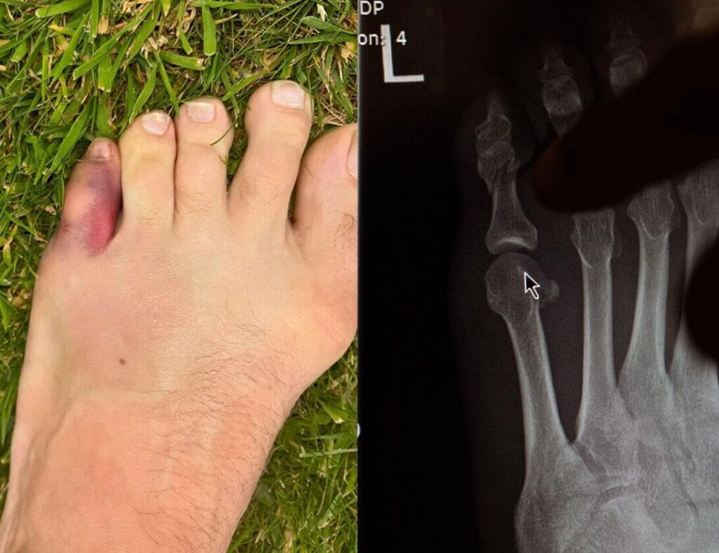 Foot was a Balloon: Conor McGregor’s Toe Injury Adds a Size to His Shoes, But He’s Ready for UFC Comeback 2 Conor McGregor