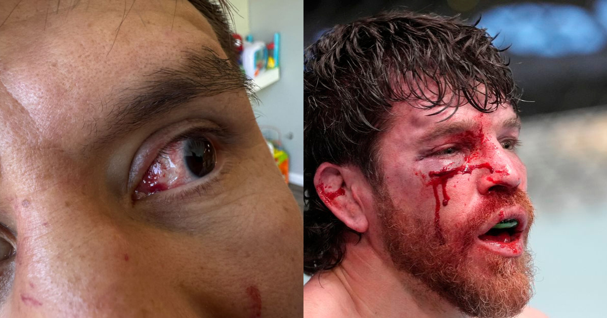 “Will It Take Someone Losing an Eye?” – Jim Miller Rips UFC’s Lack of Action on Eye Pokes