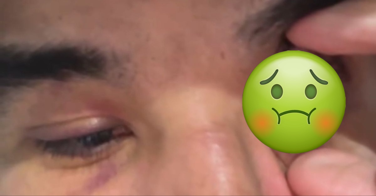 Ozzy Diaz Rushed Into Emergency Laser Eye Surgery Following UFC 313 Victory 1 Ozzy Diaz Rushed Into Emergency Laser Eye Surgery Following UFC 313 Victory