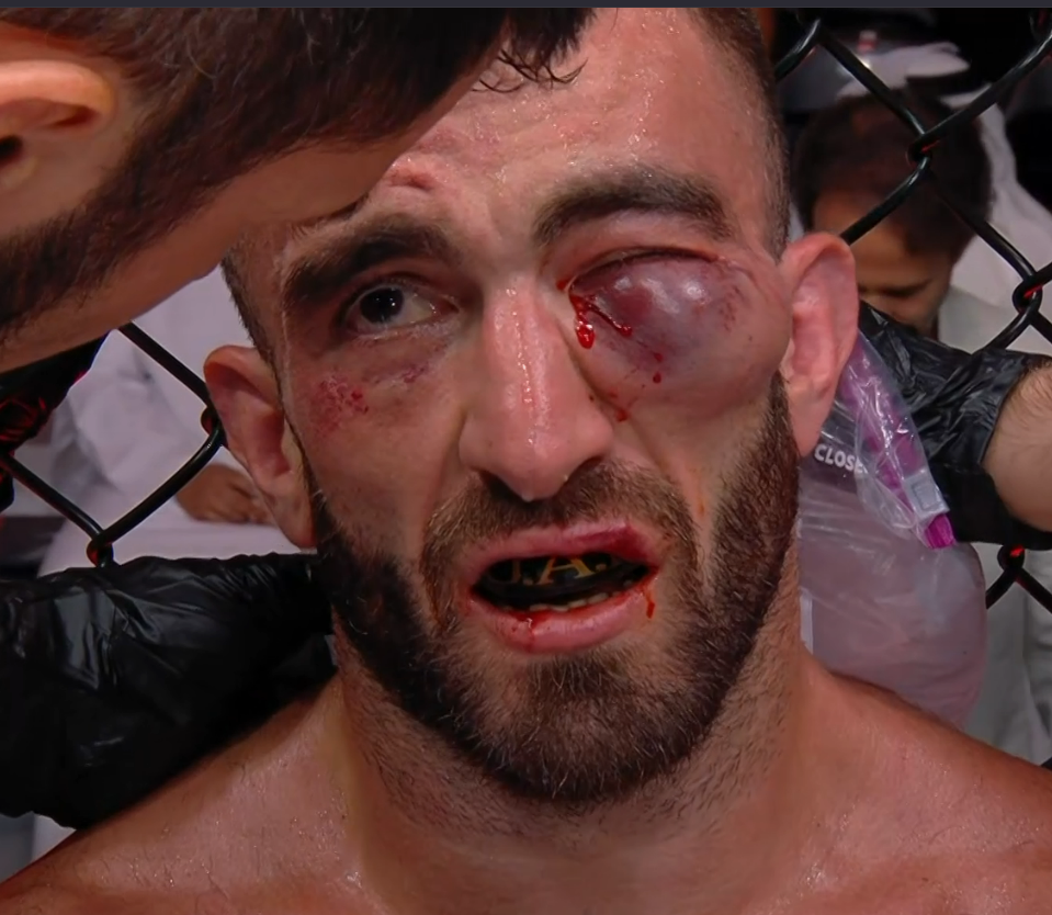 Mohammad Yahya Eye Swelling