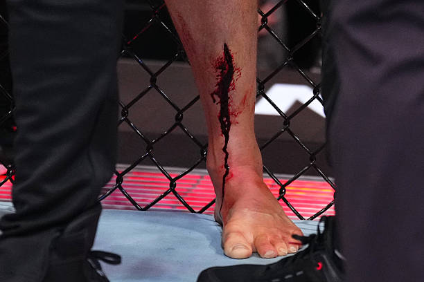 Stephen Thompson Suffers Horrific Shin Injury in Split Decision Loss to Gabriel Bonfim - UFC Nashville Highlights 8 gettyimages 2224848213 612x612 1