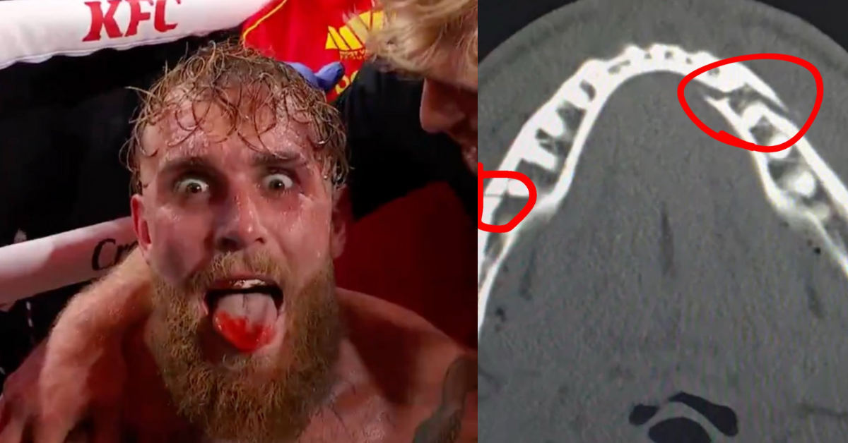 Jake Paul Injury Update: MVP CEO Confirms 6 Week Recovery Timeline
