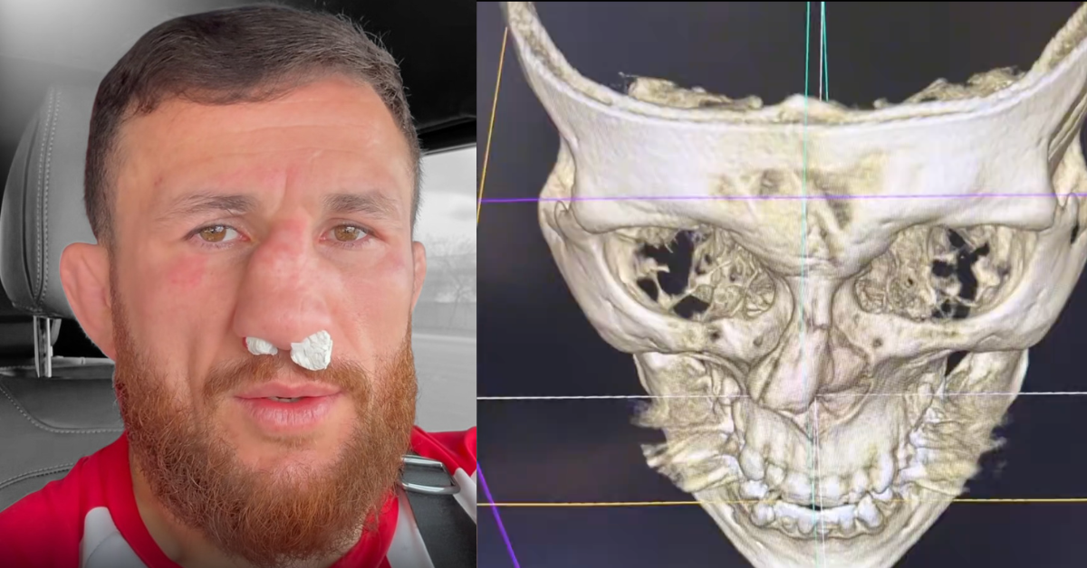 Merab Dvalishvili Shattered Nose But Is Refusing Surgery: “I can’t even breathe”